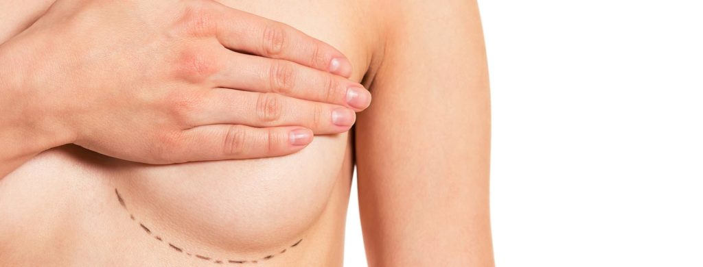 Cicatrices que se generan tras implante mamario
